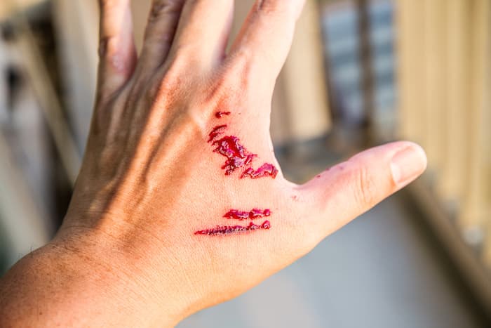 dog bite on hand